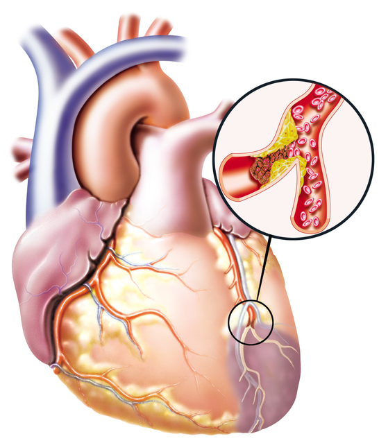 Image of a heart with impaired blood flow and blockage of a blood vessel.